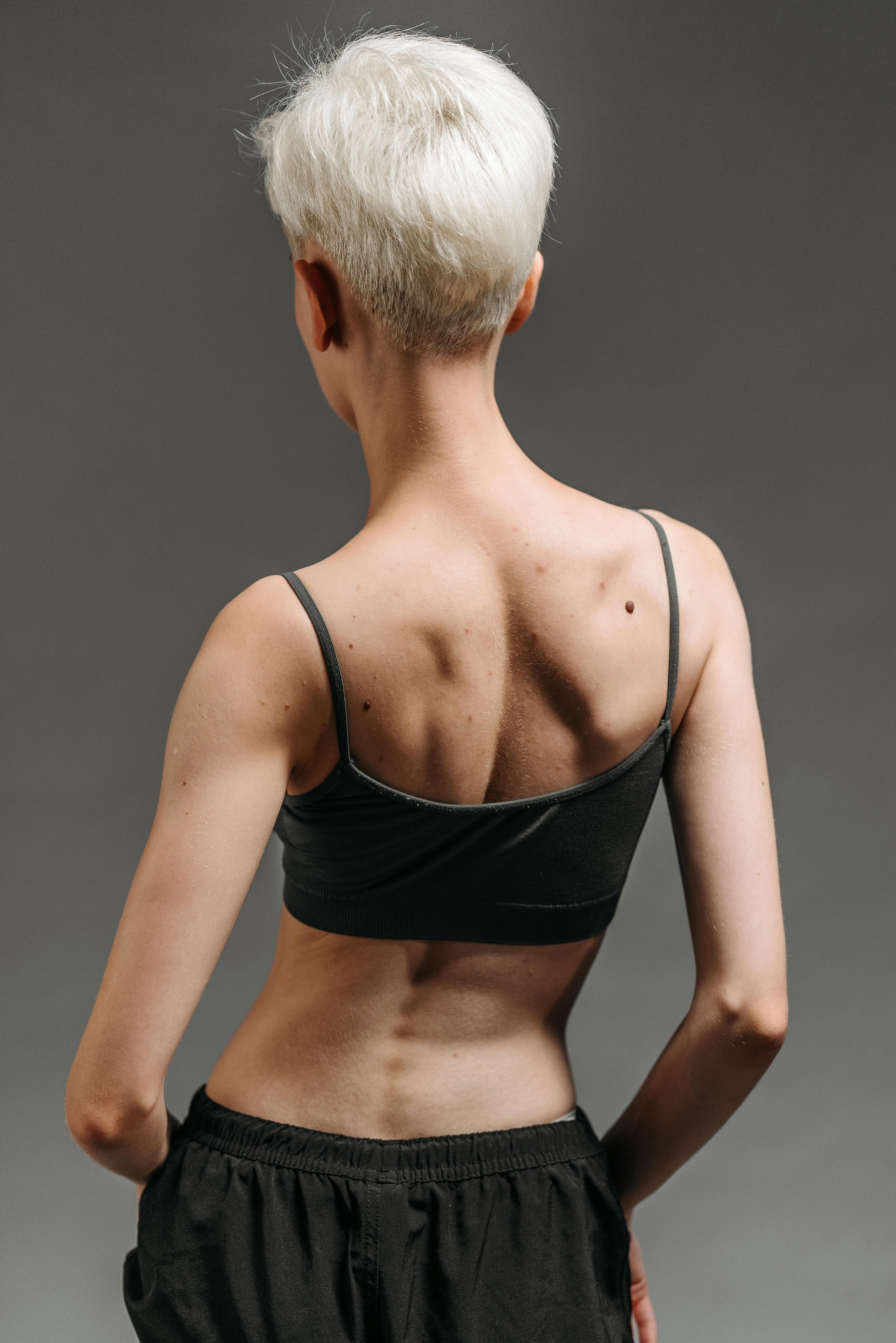 Scoliosis spinal curvature physiotherapy treatment Luxor